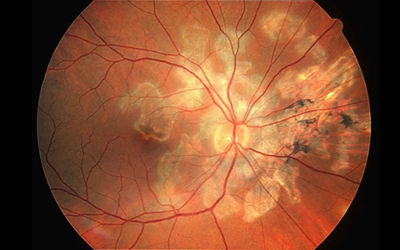 Clinical profile of serpiginous choroiditis