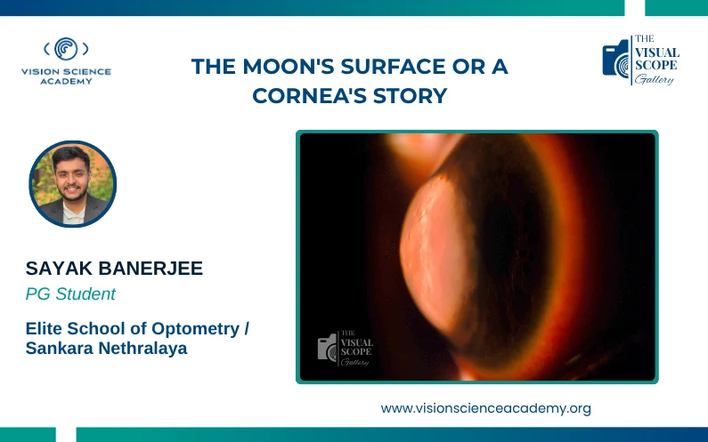 The Moon’s Surface or a Cornea’s Story?