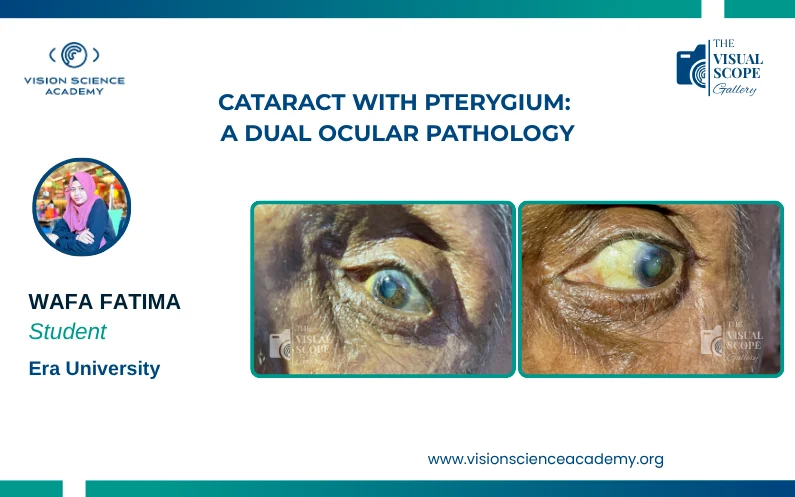 Cataract with Pterygium: A Dual Ocular Pathology