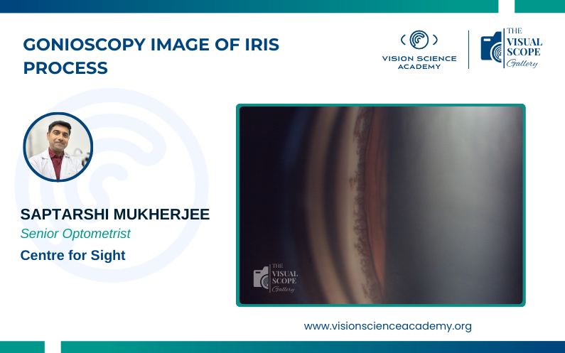 Gonioscopy Image of The Iris Processes