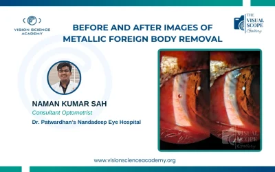 Before and After Images of Metallic Foreign Body Removal