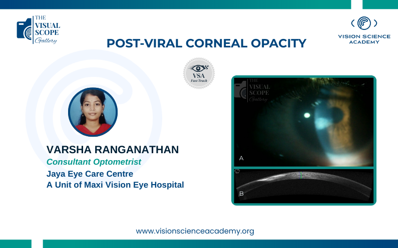 Post-Viral Corneal Opacity