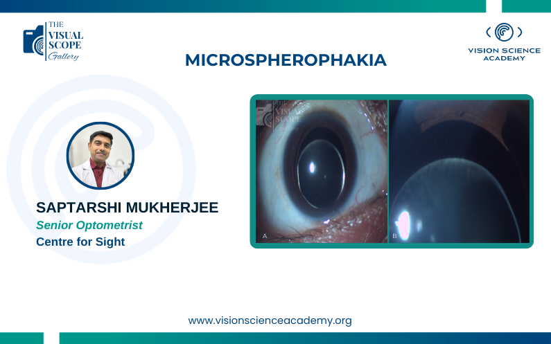Microspherophakia