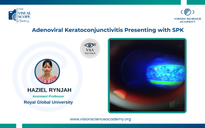 Adenoviral Keratoconjunctivitis Presenting with SPK