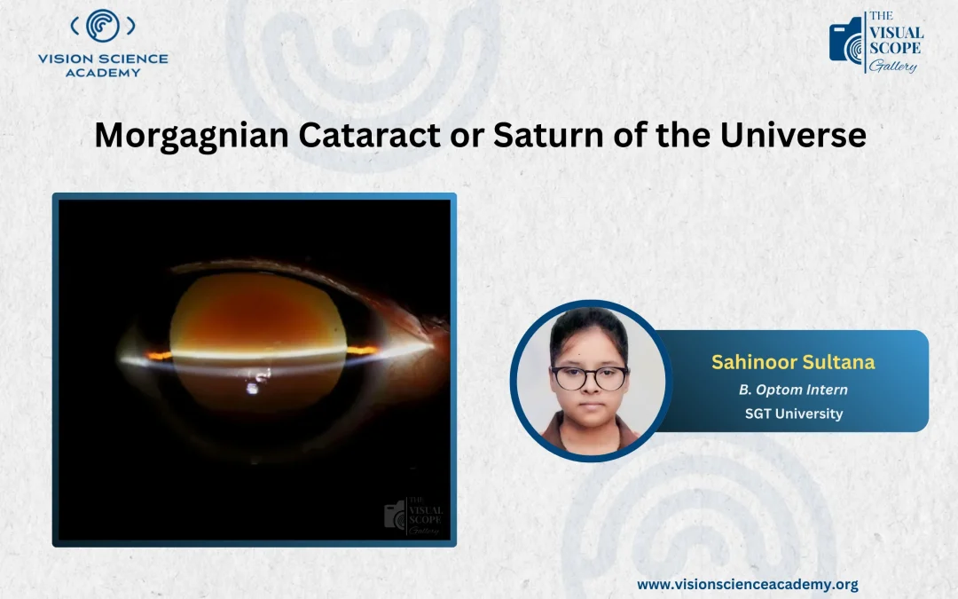Morgagnian Cataract or Saturn of the Universe