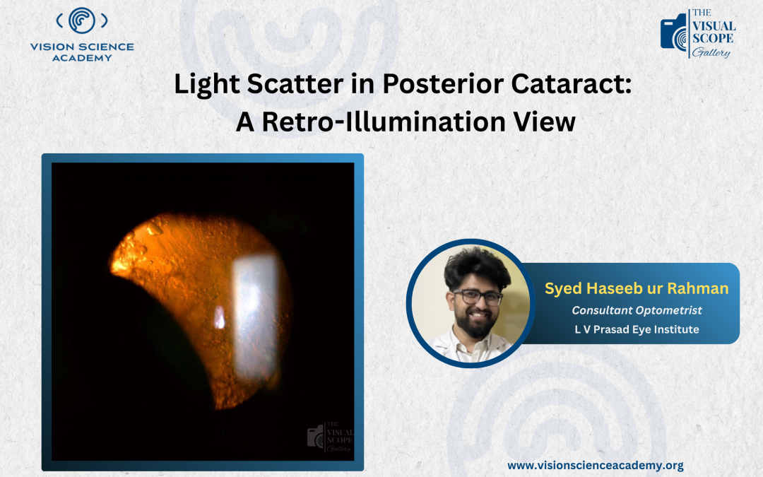 Light Scatter in Posterior Cataract: A Retro-Illumination View