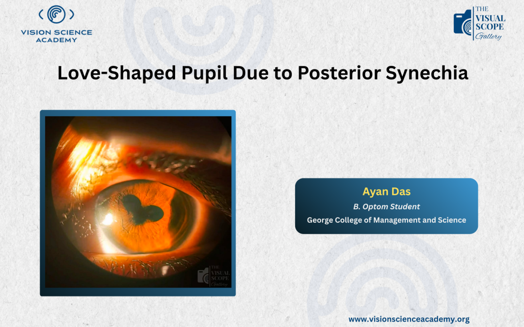 Love-Shaped Pupil Due to Posterior Synechia