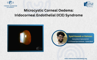 Microcystic Corneal Oedema: Iris Corneal Endothelial (ICE) Syndrome