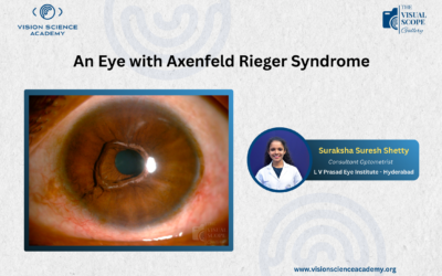 An Eye with Axenfeld Rieger Syndrome