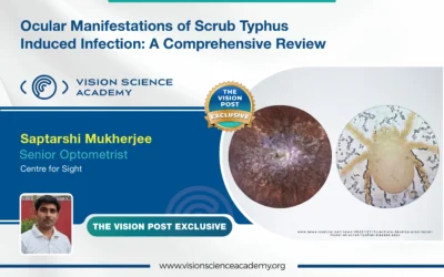 Ocular Manifestations of Scrub Typhus Induced Infection: A Comprehensive Review